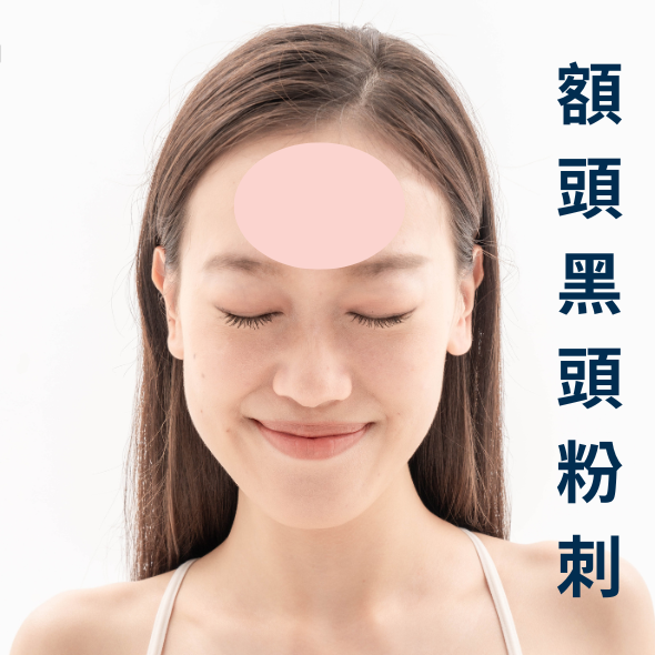 黑頭粉刺