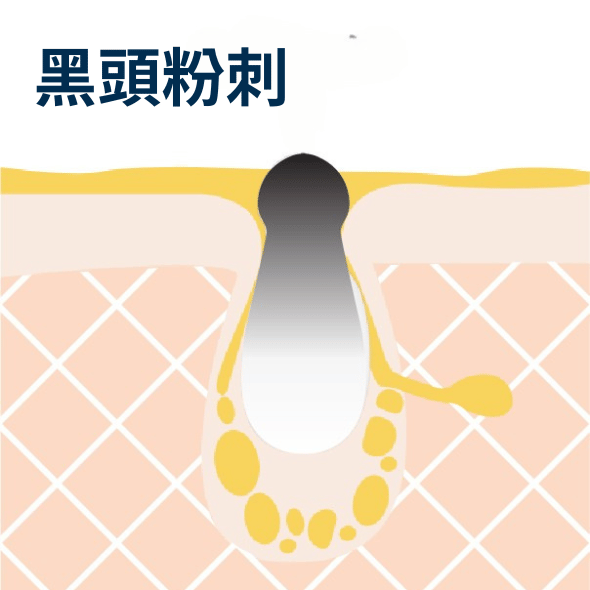 黑頭粉刺