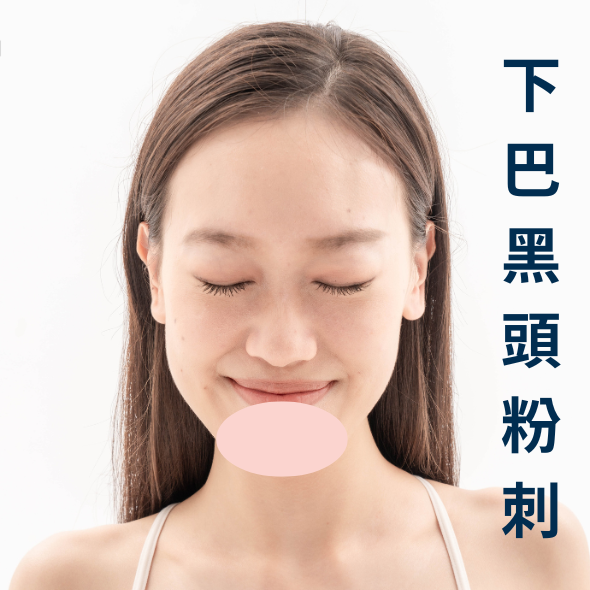 黑頭粉刺