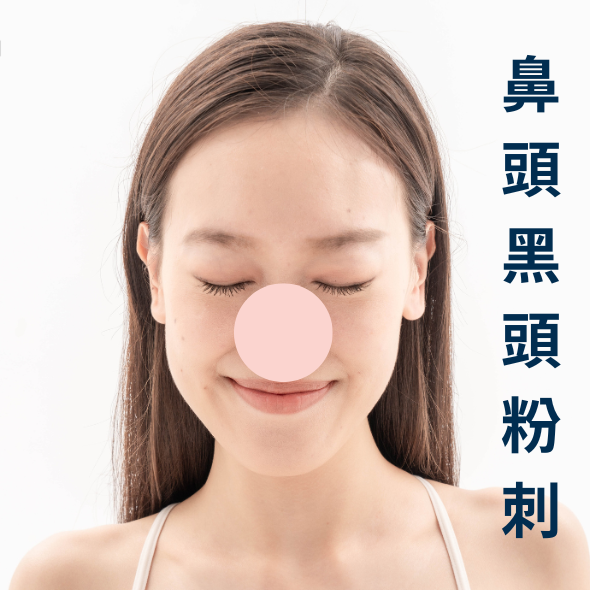 黑頭粉刺