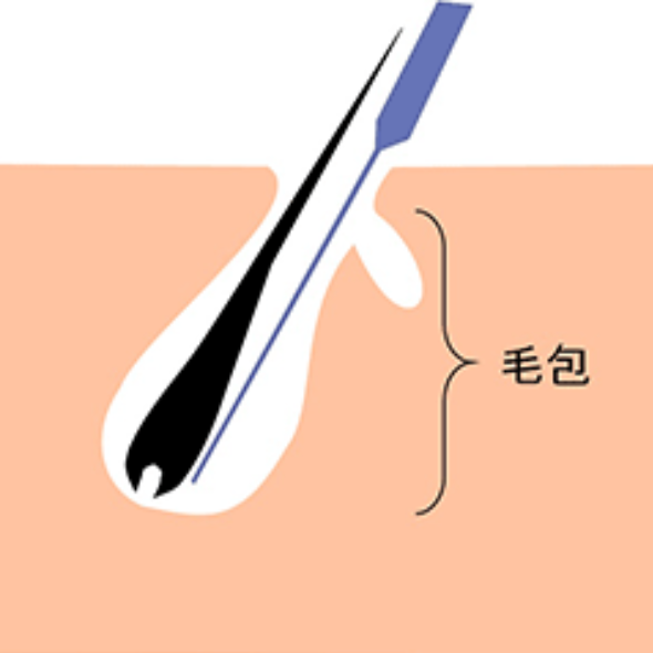 永久除毛