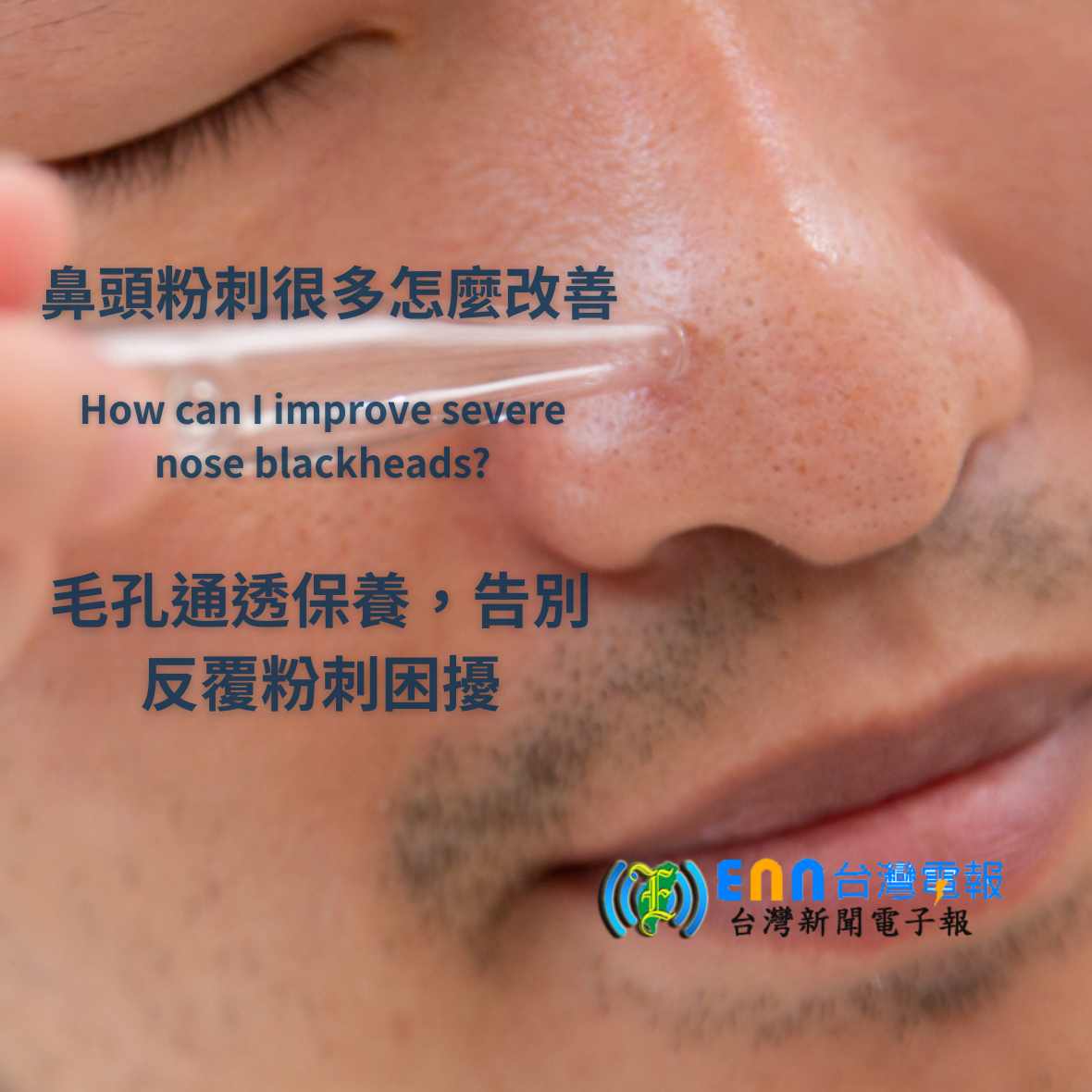 鼻頭粉刺很多怎麼改善